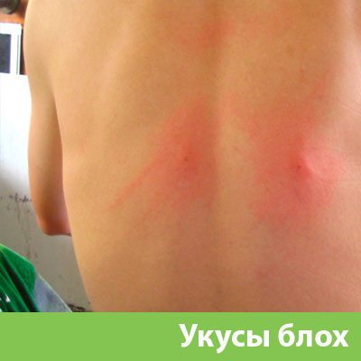 Укусы блох в Полевском