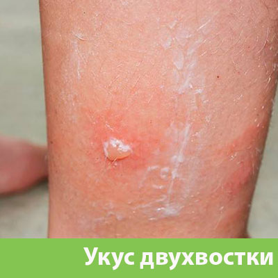 Укус двухвостки в Полевском