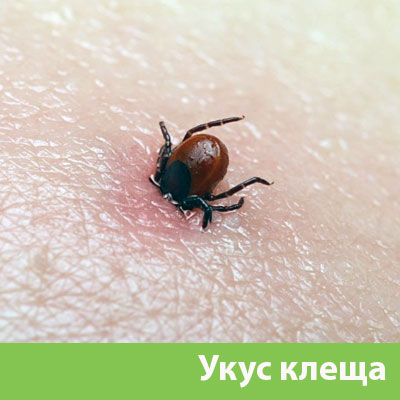 Укус клеща в Полевском