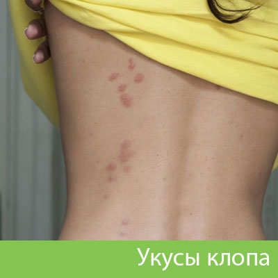 Профессиональное уничтожение клопов в Полевском